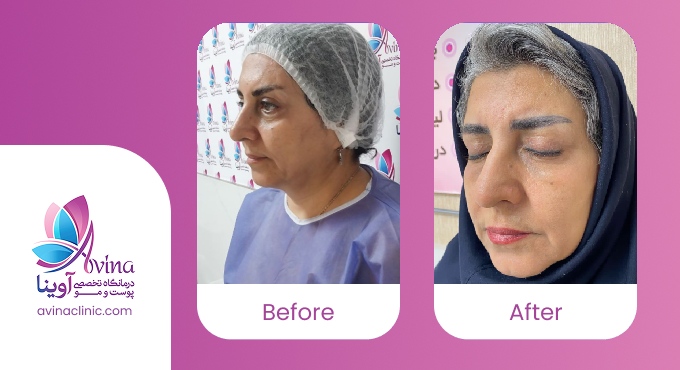 نمونه کار جوانسازی صورت با تزریق چربی در کلینیک آوینا