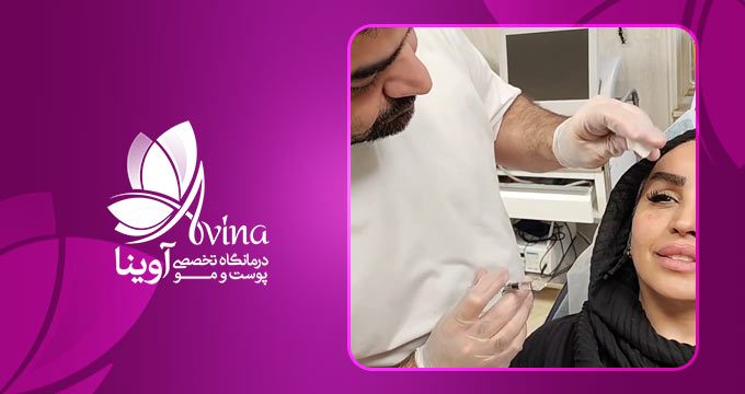 نمونه کار جوانسازی صورت با تزریق ژل در کلینیک آوینا
