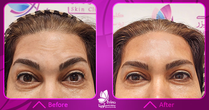 نمونه کار مزوتراپی در کلینیک آوینا