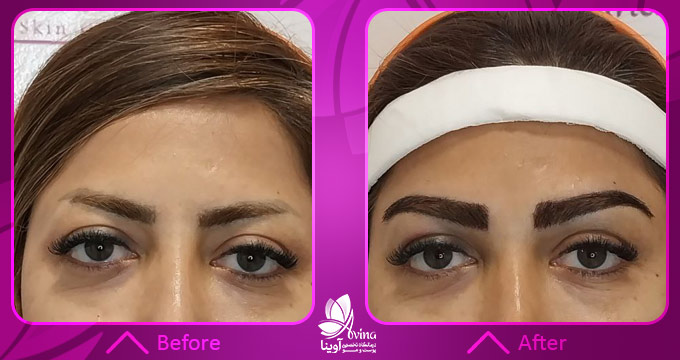 نمونه کار کاشت ابرو در کلینیک آوینا