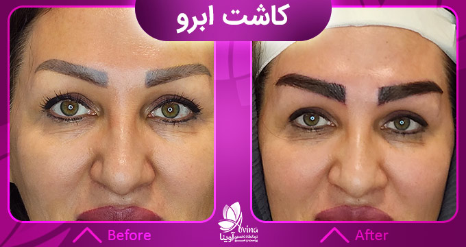 نمونه کار کاشت ابرو در کلینیک آوینا