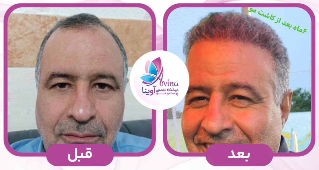 نمونه کار کاشت مو در آوینا