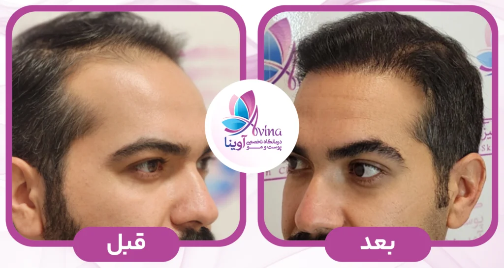 نمونه کار کاشت مو در عظیمیه
