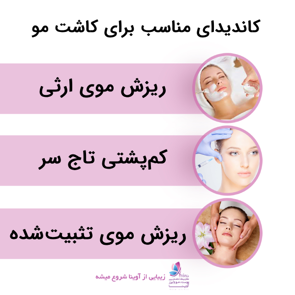 چه افرادی کاندیدای مناسب برای کاشت مو هستند؟