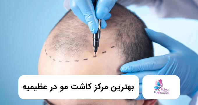 بهترین مرکز کاشت مو در عظیمیه ⭐【سال1405】