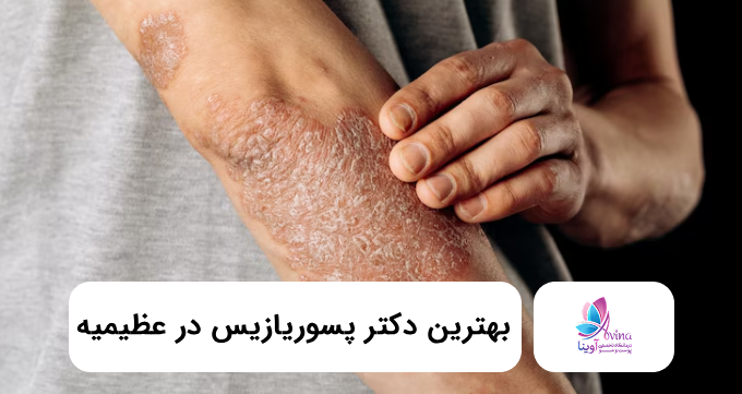 بهترین دکتر پسوریازیس در عظیمیه ✅【سال۱۴۰۵】