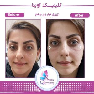 نمونه کار تزریق فیلر زیر چشم در کلینیک آوینا