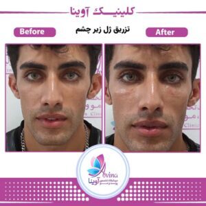 نمونه کار تزریق فیلر زیر چشم در کلینیک آوینا