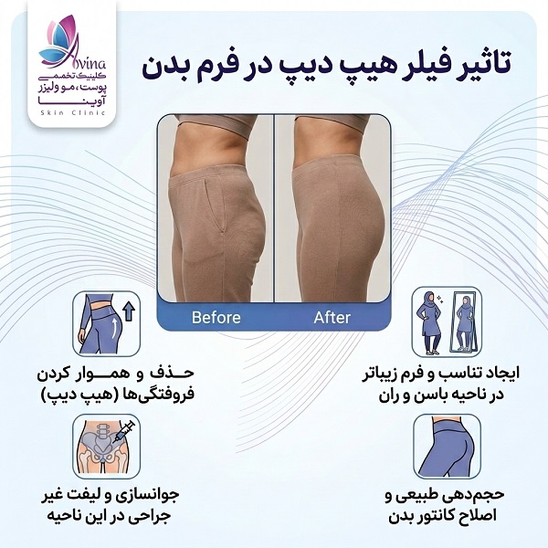 بهترین دکتر فیلر بادی در کرج